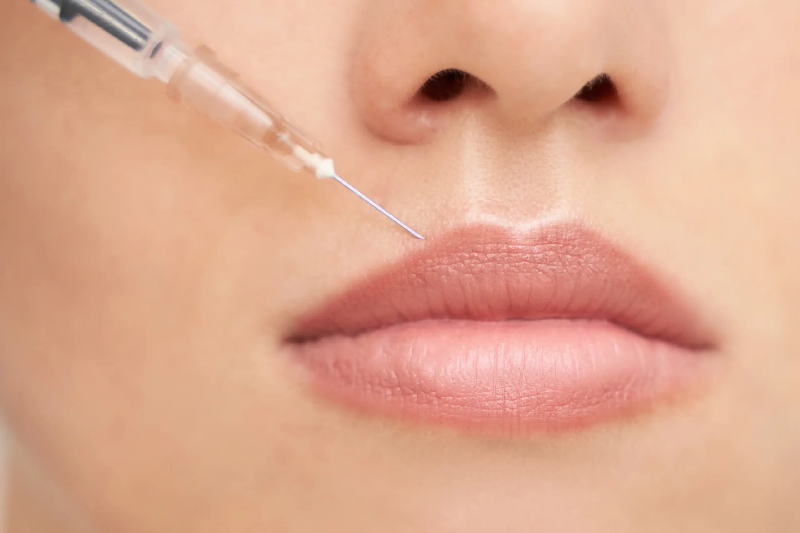 B&B-ByAge-20-dermafillers B&B-ByAge-20-dermafillers lip filler