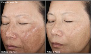Before and after of Rejuvenize chemical peel results for hyperpigmentation and melasma