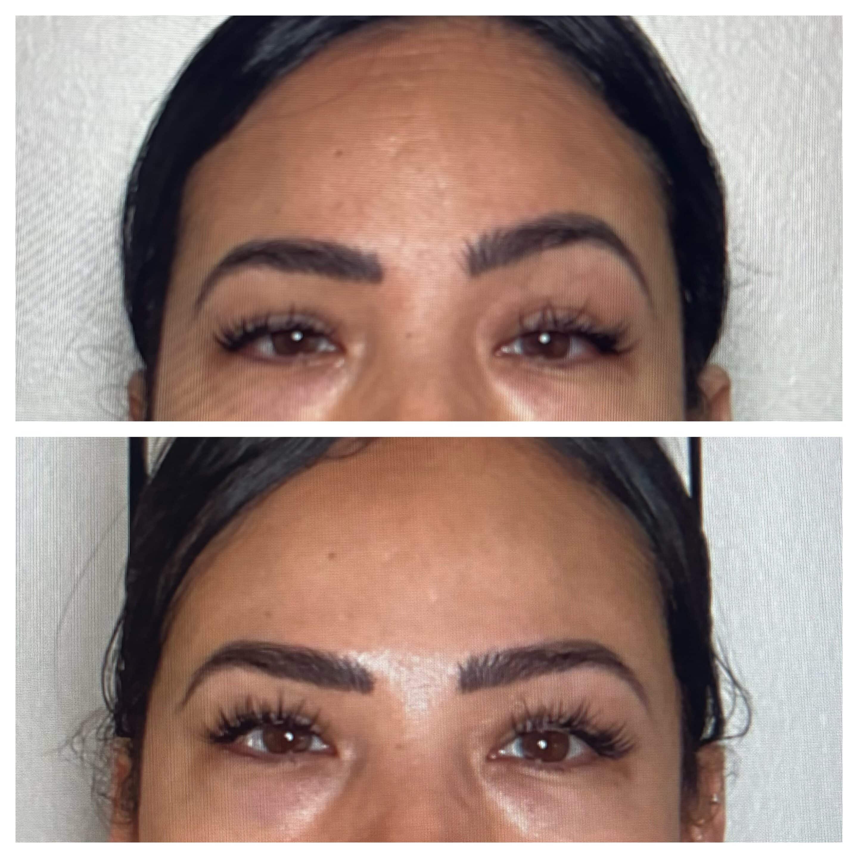 Brow asymmetry correction and brow lift with Dysport at Banyan and Bamboo Austin TX