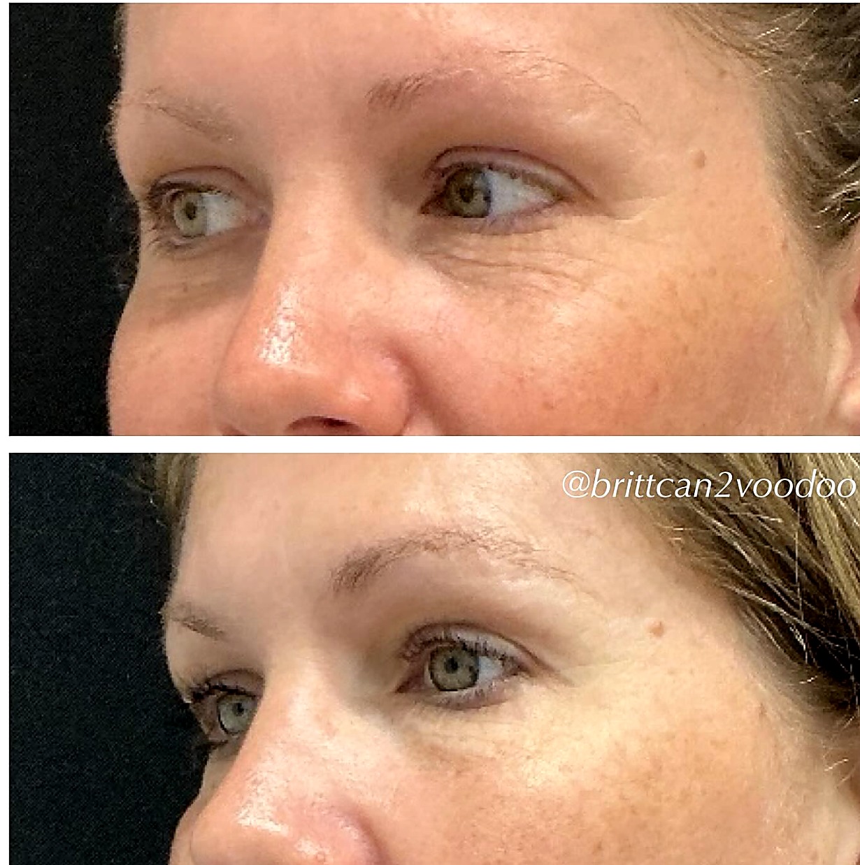 Crow's feet and eye area before and after Dysport at Banyan and Bamboo Austin