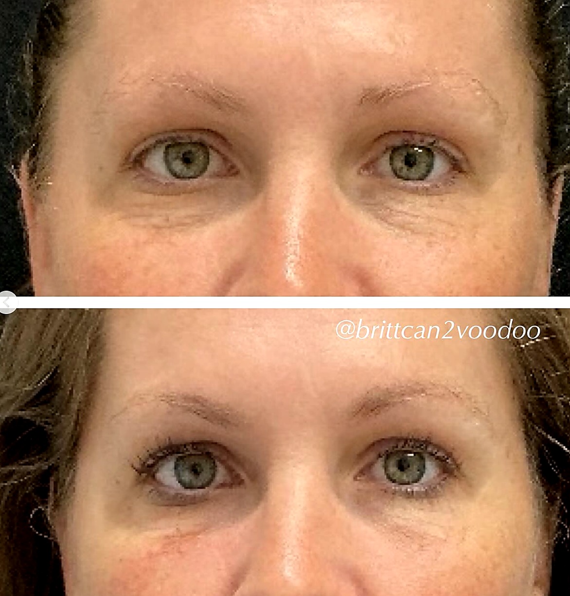 Brow hooding and droop before and after Dysport at Banyan and Bamboo Austin