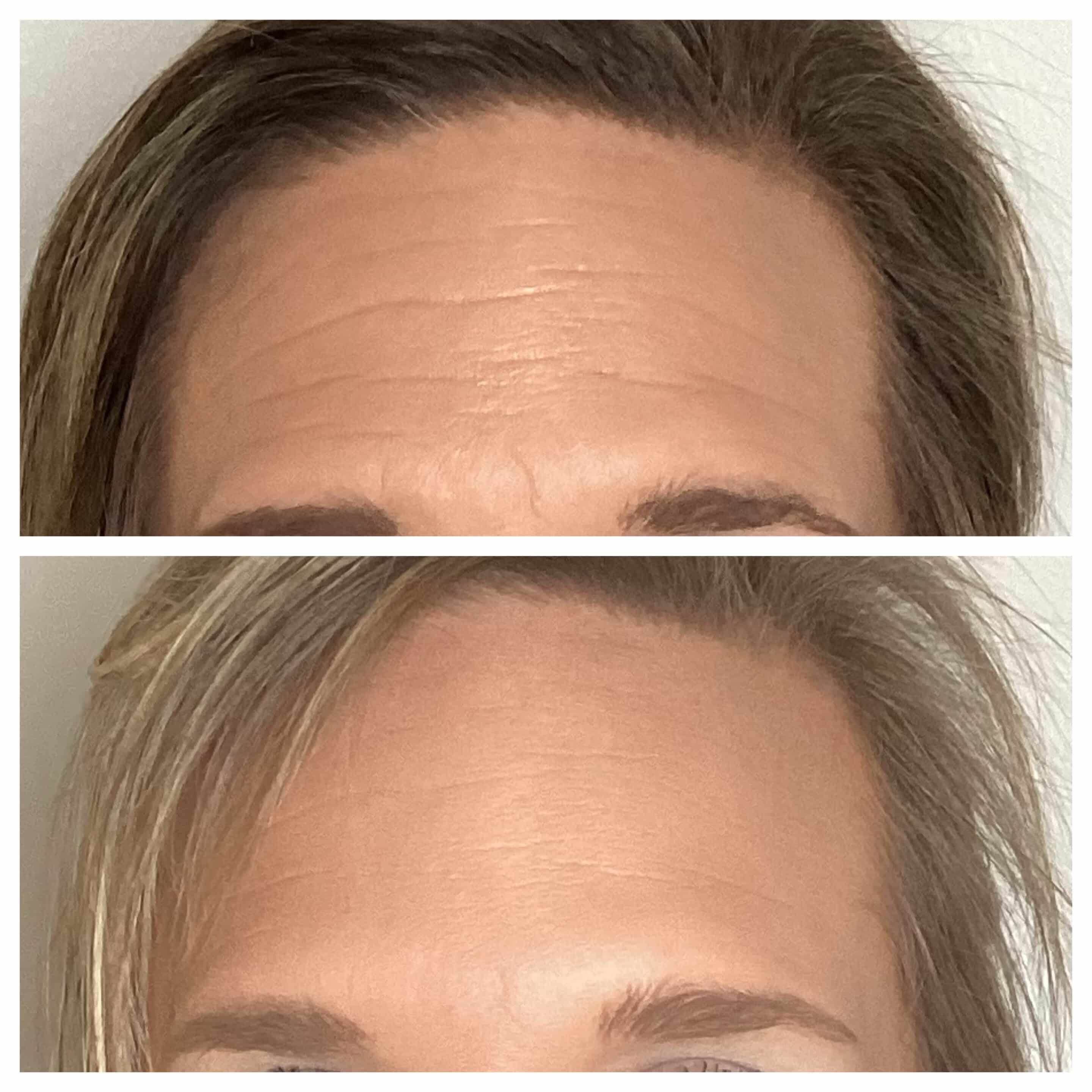 Deep static forehead lines before and after Dysport at Banyan and Bamboo Austin TX