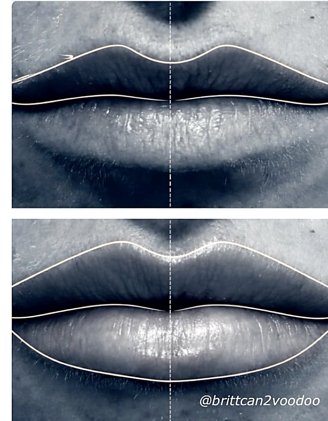 Facial balancing before and after — Lip Enhancement — Filler — Banyan & Bamboo Austin