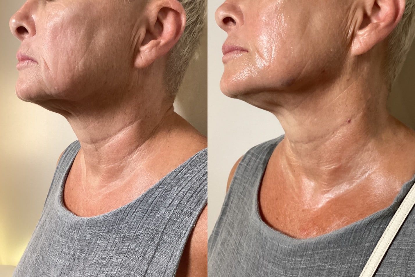Sculptra jawline and profile before and after at Banyan and Bamboo Austin TX