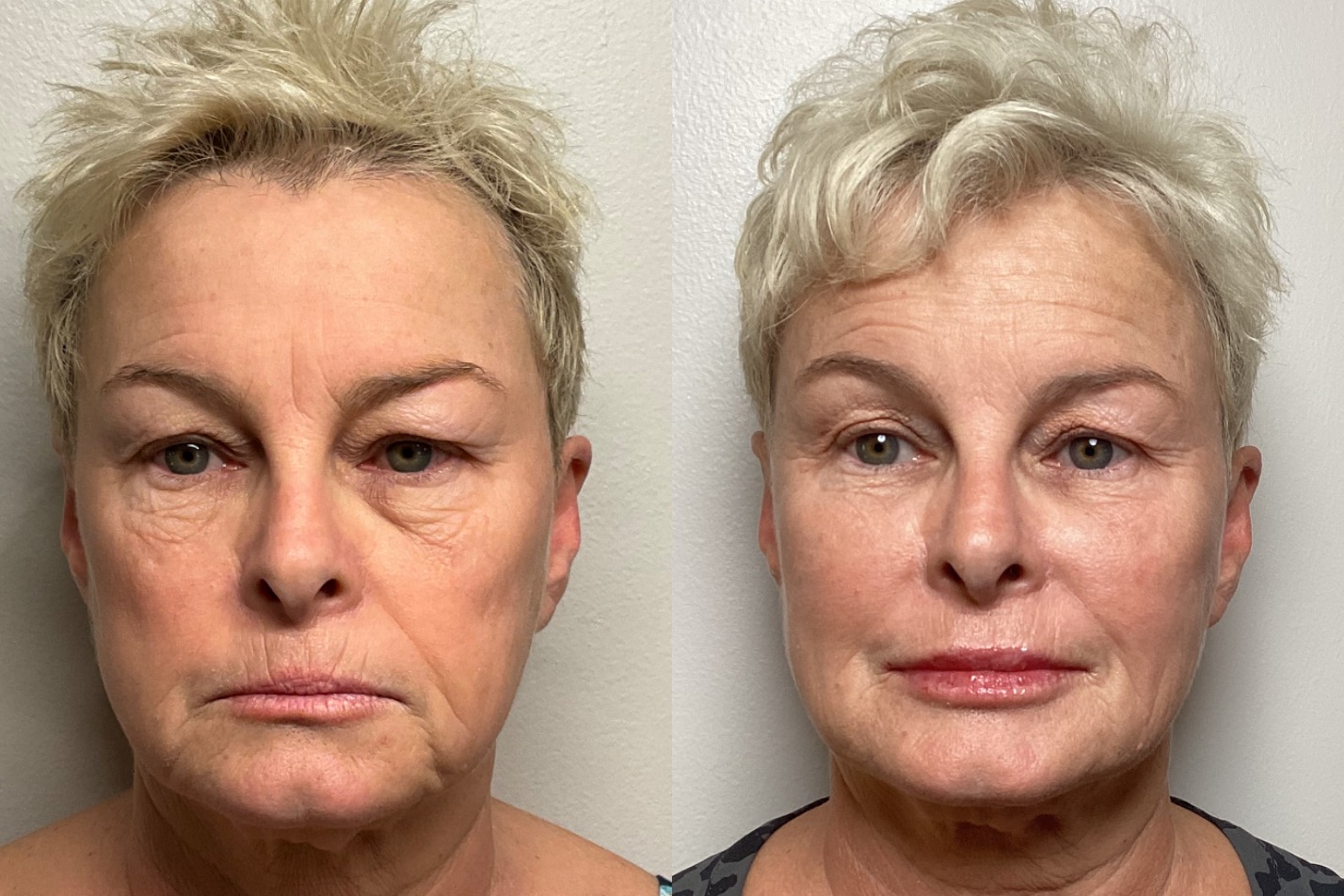 Sculptra and filler full face before and after at Banyan and Bamboo Austin TX