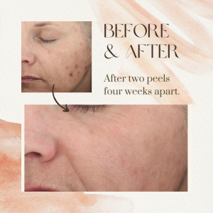 Chemical peel facial anti-aging acne